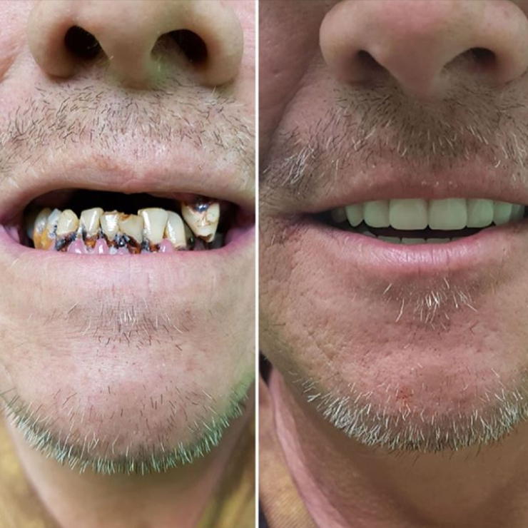 Before and after surgical denture case