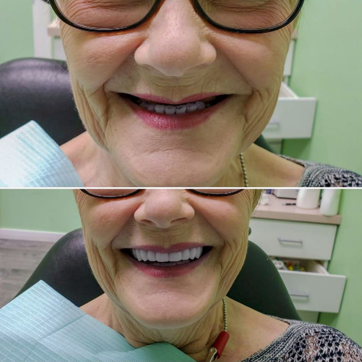 Before and after upper denture case