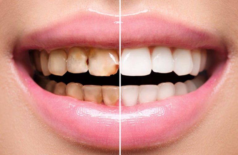 Immediate surgical dentures