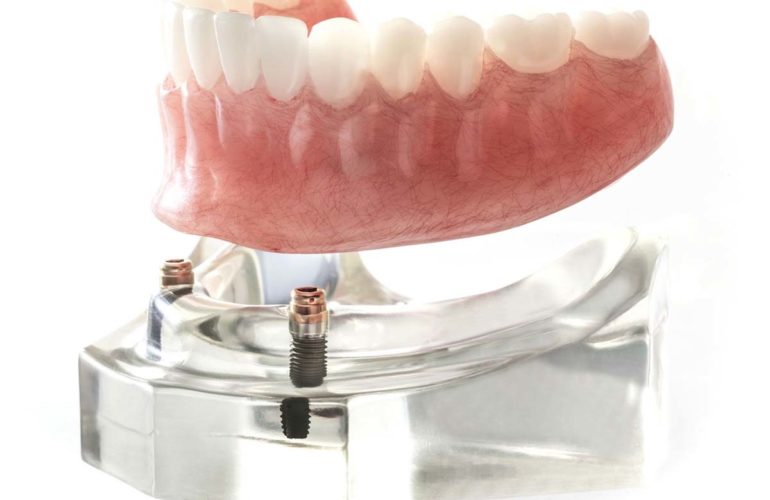 Implant supported dentures
